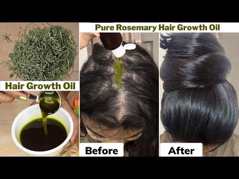 I used👆🏼this Rosemary Hair Growth Oil on Thinning Hair & Bald Scalp-Got 10 times Thick Hair Growth