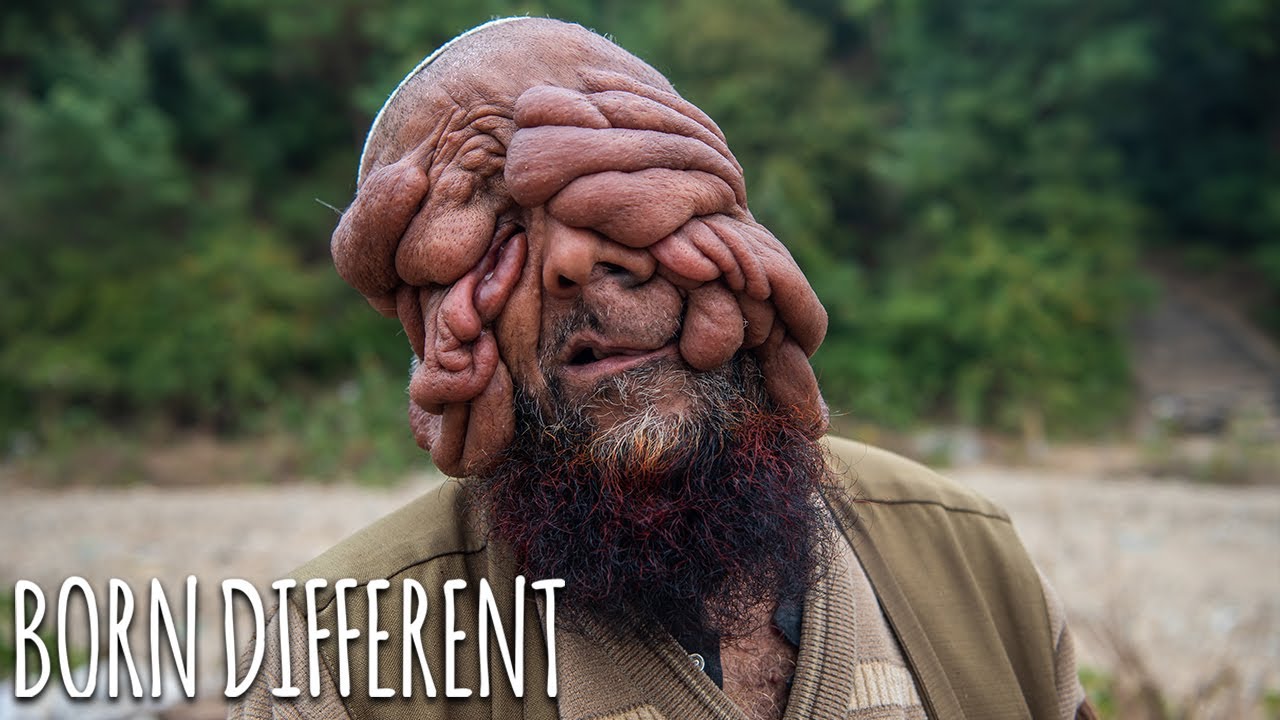 They call me 'the man with no face' - born different