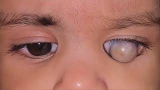 Queratomalacia