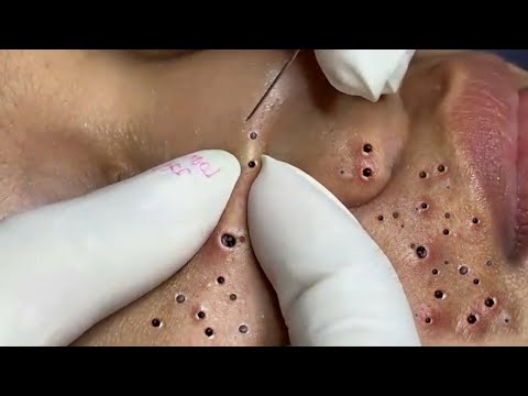 Blackheads and Acne Treatment With Xinh Spa #27102023