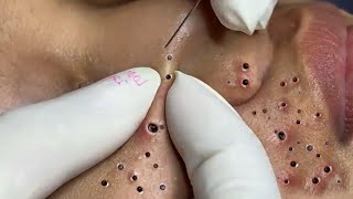 Blackheads and Acne Treatment With Xinh Spa #27102023