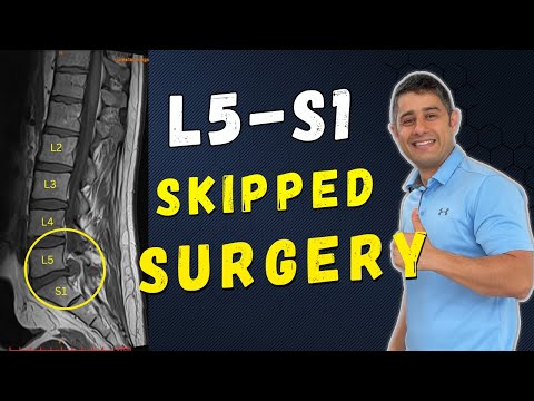 L5 - S1  Disc Herniation Recovery without surgery (online client testimonial) #canada