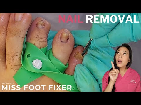 Damaged Nail Gently Removed | Expert Nail Extraction Procedure