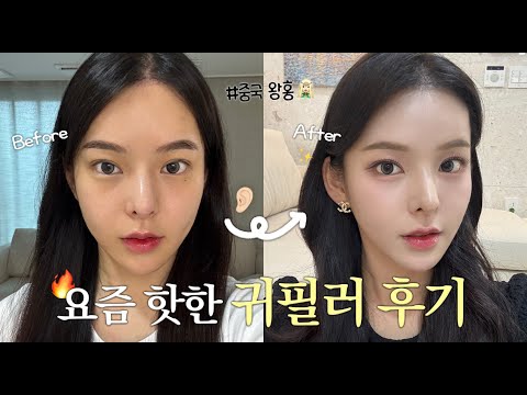요즘 SNS에서 핫한 중국 왕홍 귀필러 저도 맞아봤습니다 👂🏻 (중안부 짧아보임‼️)