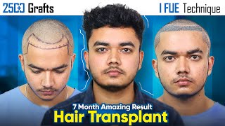 2500 Grafts Hair Transplant in Bhopal | Amazing Results & Affordable Cost in Bhopal #hairtransplant