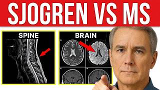 7 Sjögren's Neurological Symptoms Mistaken for Multiple Sclerosis (MS) & POTS (Could Save Your Life)