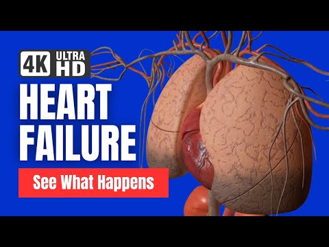 Heart Failure - See What Happens - 3D Animation