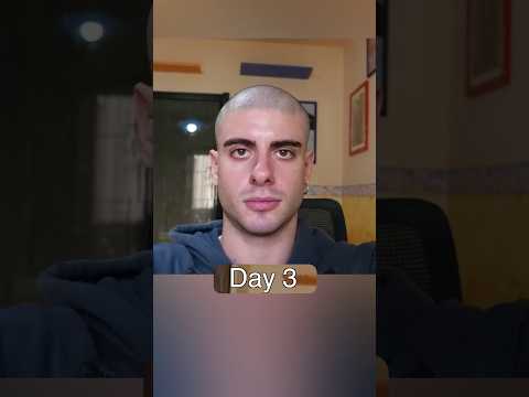 zero hair in 361 days