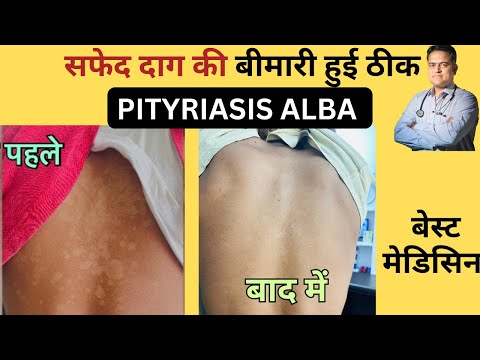 दाग की बीमारी हुई ठीक । Pityriasis alba recoverd completely with homeopathy ।