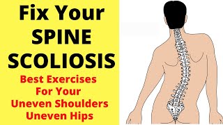 Fix Your Spine Scoliosis | Best Exercises For Scoliosis | Exercises For Uneven Shoulders And Hips