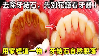 去除牙結石，先別花錢看牙醫！用家裡這一物，自己在家去除牙結石！讓牙結石自然脫落，牙齒清潔乾淨、口臭也沒了！