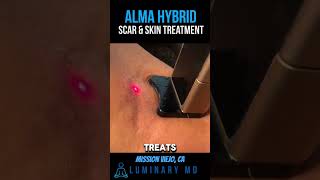 Over 30 Suffering from scars or uneven skin? Meet the Alma Hybrid at Luminary MD #skincare #scars