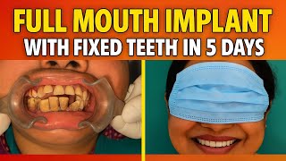 Full Mouth Implants Transformation in 5 Days 🦷 | Fixed Teeth with Smile Makeover Before & After😊