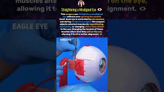 How Surgeons Fix Crossed Eyes 👁️😱 #strabismus #surgery #shorts