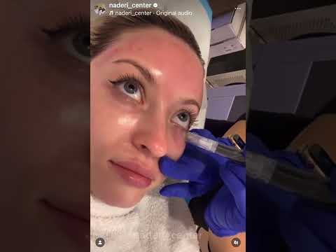 Collagen boosting treatment PRP Microneedling Before & After ✨ #collagen #prpskin #skincare