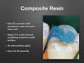 Composite and Amalgam Restoration Techniques