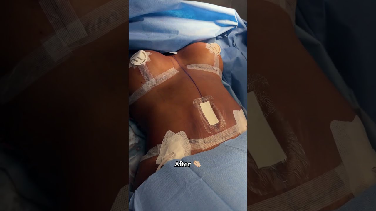 Post-surgery recovery with dressings visible.