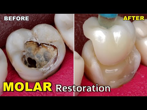 Extremely Conservative Tooth Restoration By Half Crown! Incredible To Watch