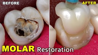 Extremely Conservative Tooth Restoration By Half Crown! Incredible To Watch