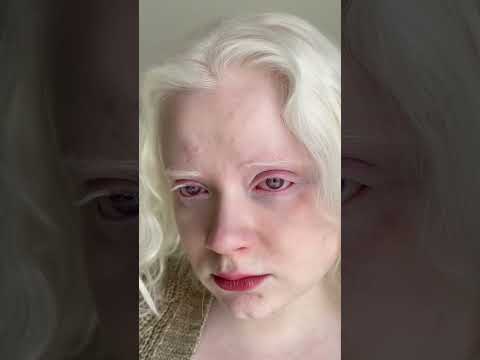 #shorts Why Do My Eyes Shake? All About my Nystagmus