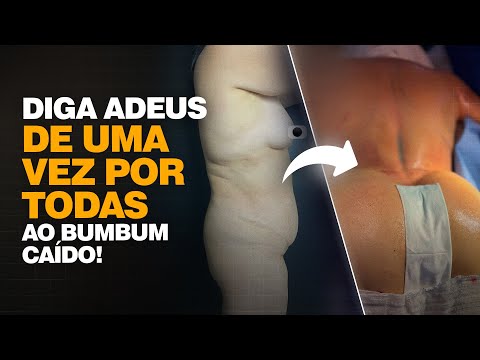 Glúteo Redondinho com Lipo HD: Fim do Bumbum Caído! | Cirurgia Plástica | Dr. Ícaro Samuel