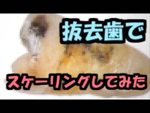 ㉗　抜去歯のスケーリング【ガリガリします】