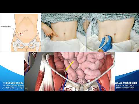 Tiếp cận siêu âm đau hố chậu phải (BS Nguyễn Quang Trọng)