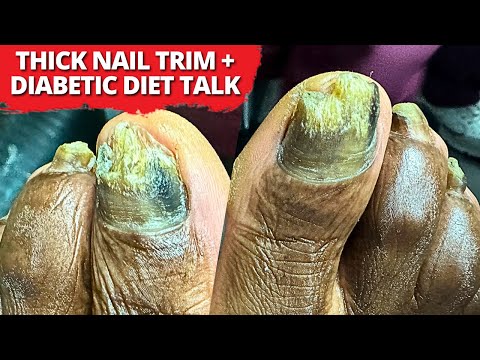 Satisfying Diabetic Toenail Trim + Healthier Diet Discussion