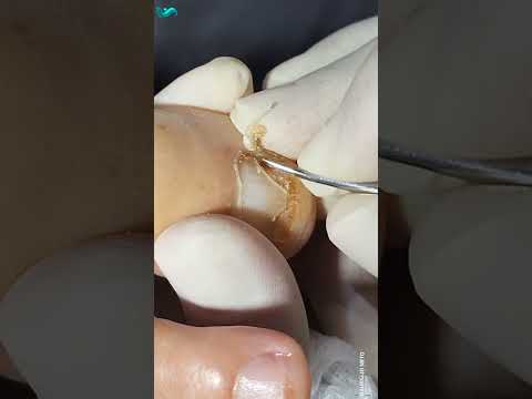 ALÍVIO IMEDIATO DA UNHA ENCRAVADA! #podologomaurelio #short