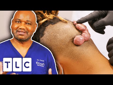 Dr. Sandra Lee & Dr. Umar Treat Very Large Keloids | Dr. Pimple Popper