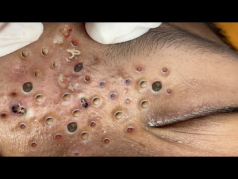 Blackhead Removal With Sac Dep Spa @100074286