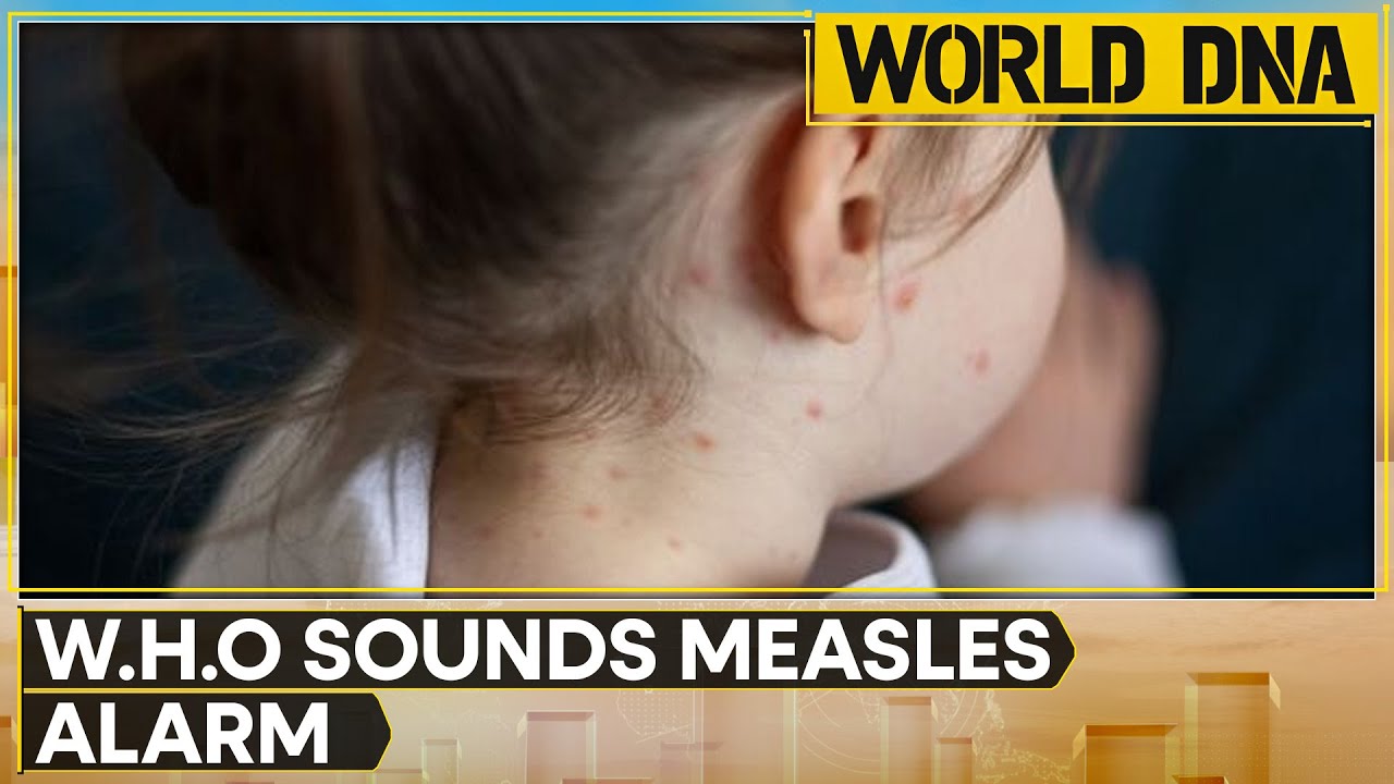 UK health chief sounds alarm over falling measles vaccinations