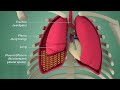 Pleural Effusion Management and Diagnosis