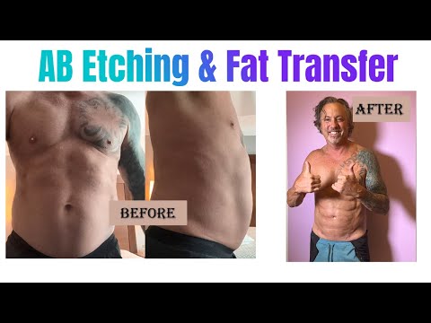 53-Year-Old Transforms His Abs with Dr. Curves | Ab Etching + Fat Transfer Journey #plasticsurgery