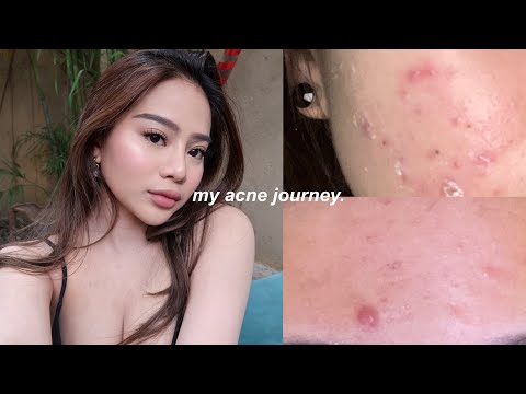 HOW I CLEARED MY SKIN | my acne journey, skincare, tips.