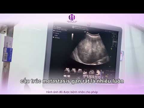 Một ca siêu âm phát hiện hàng loạt tổn thương di căn khiến bác sĩ lặng người
