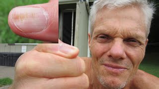 Indentations or Ridges in Thumbnail.   What Does it Mean?