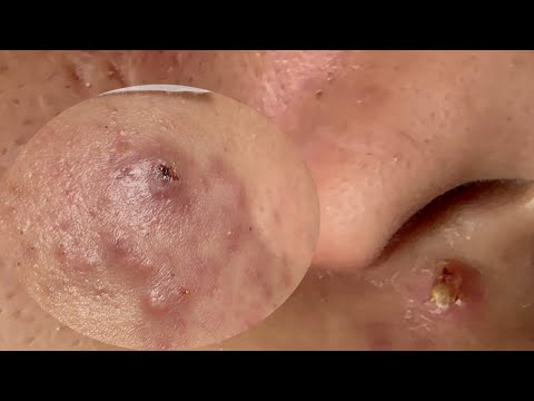 Acne Treatment Huong Da Nang#735 Have a nice day!