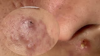 Acne Treatment Huong Da Nang#735 Have a nice day!