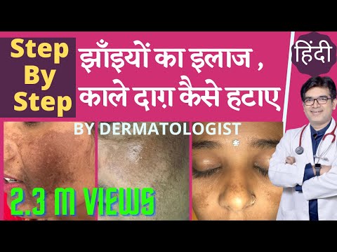 झाँइयों का इलाज | झाँइयों की बेस्ट क्रीम | चेहरे के काले दाग़ हटाने के तरीक़े | Dermatologist| Hindi