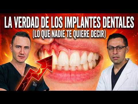 Lo que NADIE te dice de los implantes dentales