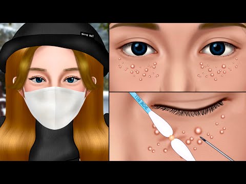 ASMR Multiple Milia Extraction Animation, Whitehead Removal, Makeup