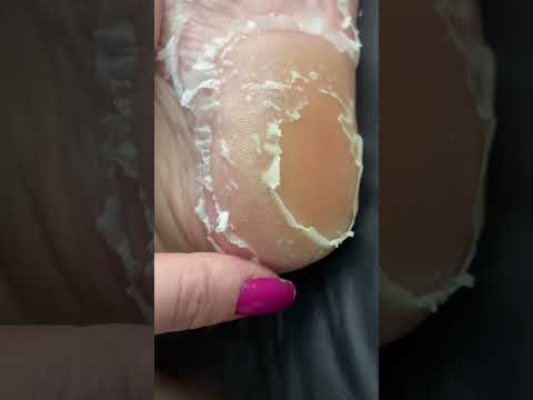 Como salvar os pés do ressecamento fiquei chocada com o resultado 😱 #autocuidado #cuidadoscomapele