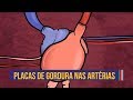 Saúde Cardiovascular e Ateromas