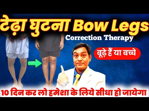 10 दिन कर लो टेढ़ा घुटना हमेशा के लिये सीधा हो जायेगा | Bow legs correction #bowlegs