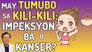 May Tumubo sa Kili-Kili: Impeksyon Ba o Kan-ser? - By Doc Willie Ong (Internist and Cardiologist)