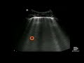 Vertical Artifacts in Pulmonary Diagnosis