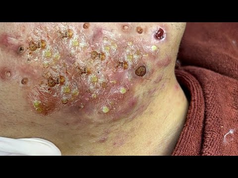 𝘼𝙘𝙝𝙞𝙚𝙫𝙚 𝙄𝙣𝙣𝙚𝙧 𝙋𝙚𝙖𝙘𝙚 𝙬𝙞𝙩𝙝 𝙁𝙖𝙘𝙞𝙖𝙡 𝘾𝙡𝙚𝙖𝙣𝙨𝙞𝙣𝙜 #𝟔𝟎𝟏𝟕