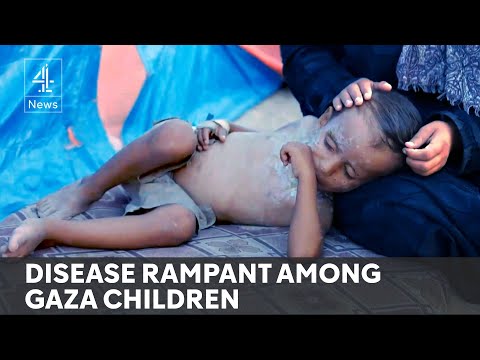 Malnutrition and terrible sanitation lead to epidemic of skin infections in Gaza