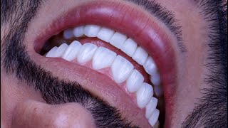 A brilliant new smile complete✨🦷 #smiles #sonrisaperfecta #carillasdentales #smiledesign #dentista